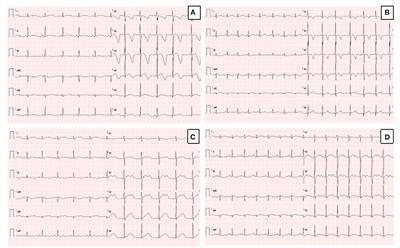 Long QT syndrome and left ventricular non-compaction in a family with KCNH2 mutation: A case report